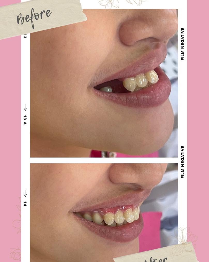 Orthodontic Alignment — Teeth Straightening at Fradejas Dental Care Clinic